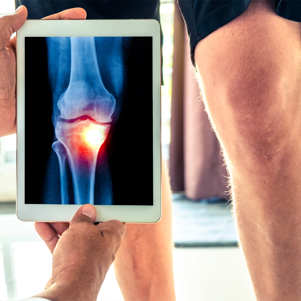 Genicular Knee Ablation