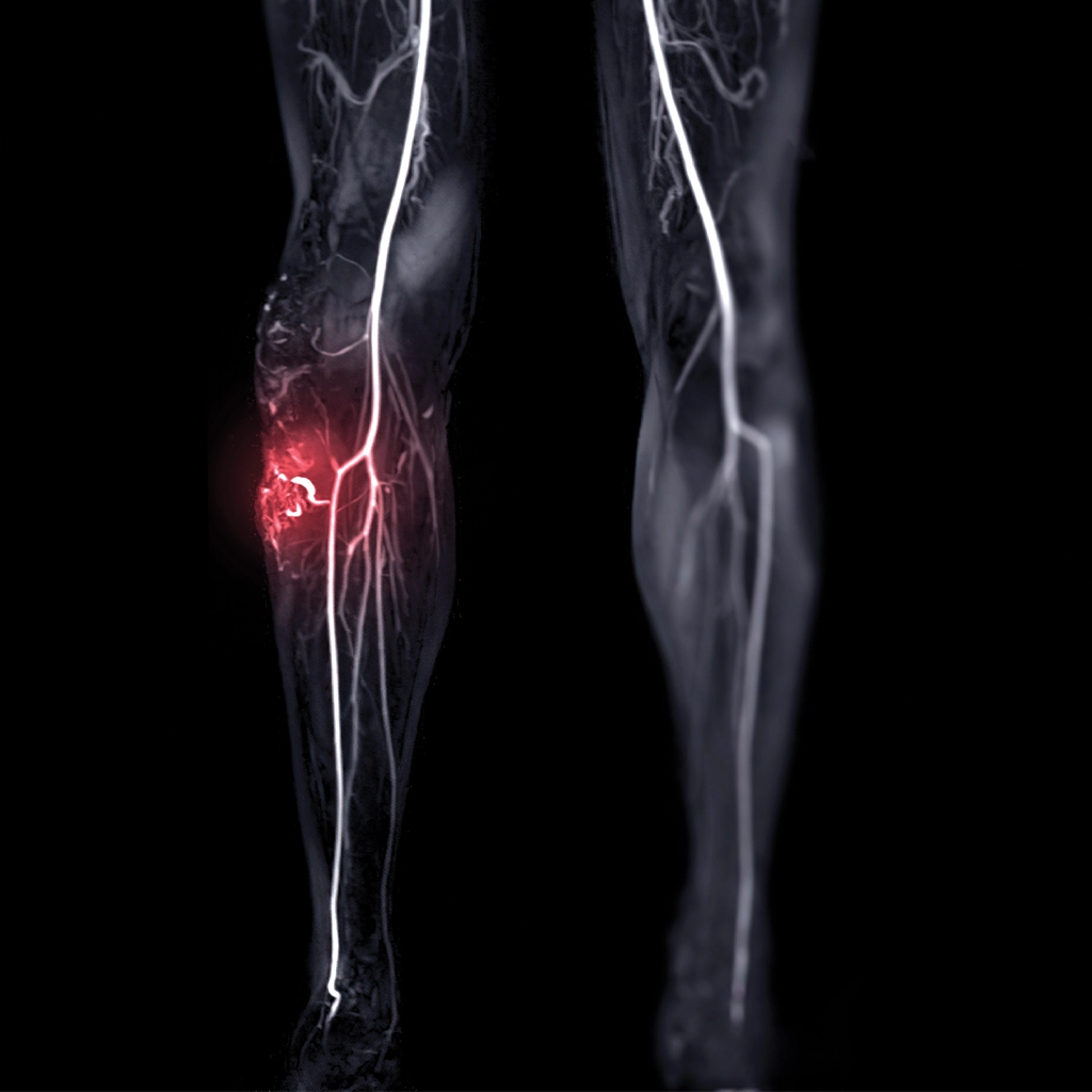 Vascular Malformation Treatment