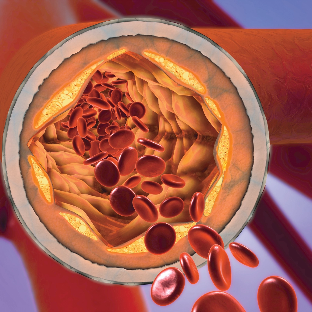 Peripheral Vascular Angiography/Intervention