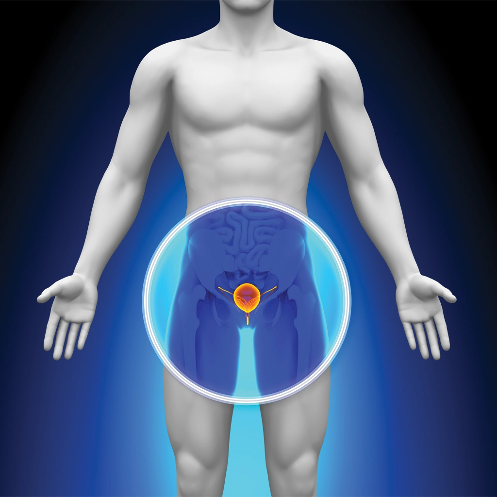 Prostate Artery Embolization (PAE)