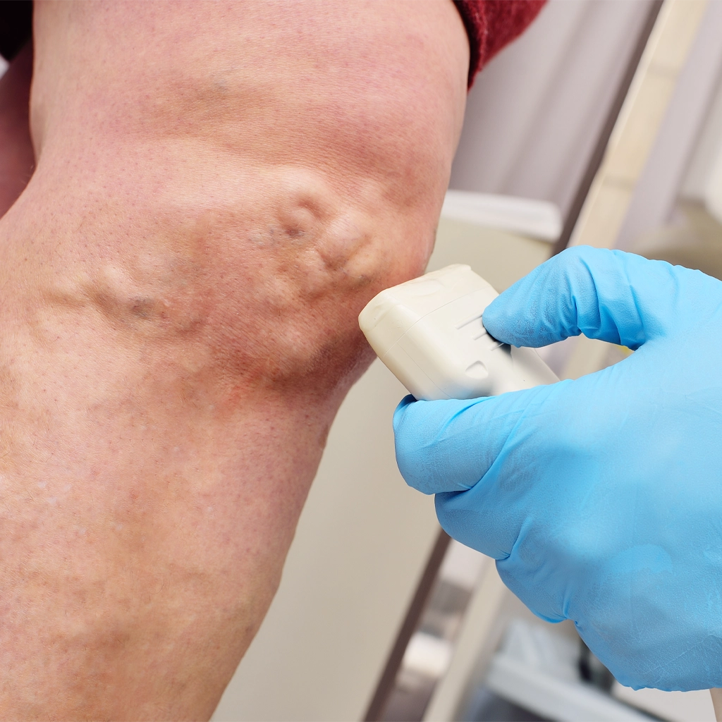 Varicose Vein Ablation