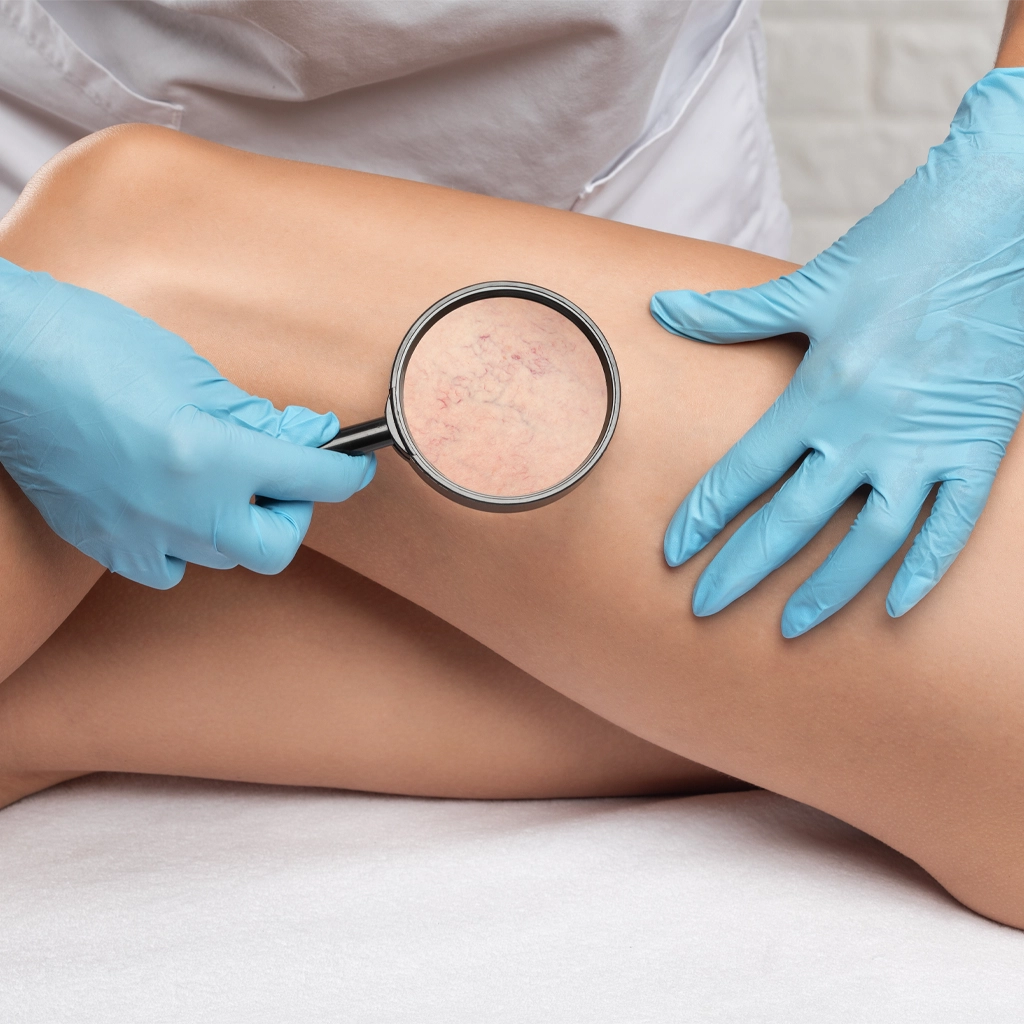 Sclerotherapy