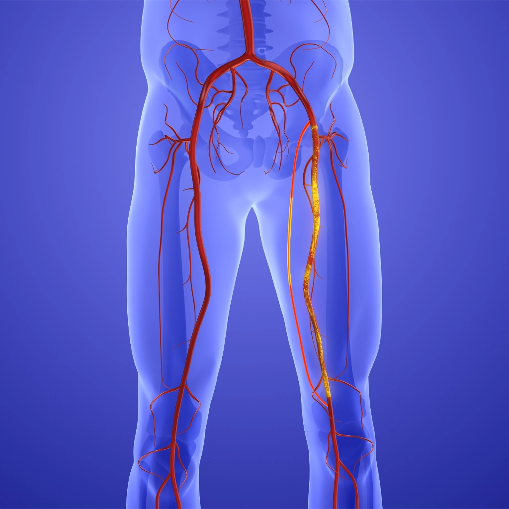 Peripheral Vascular Angiography/Intervention