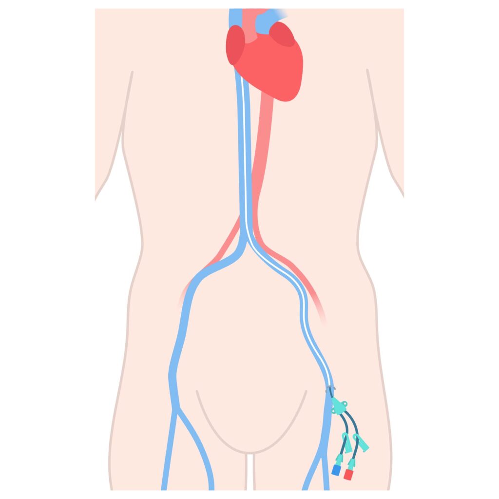 Venous Access