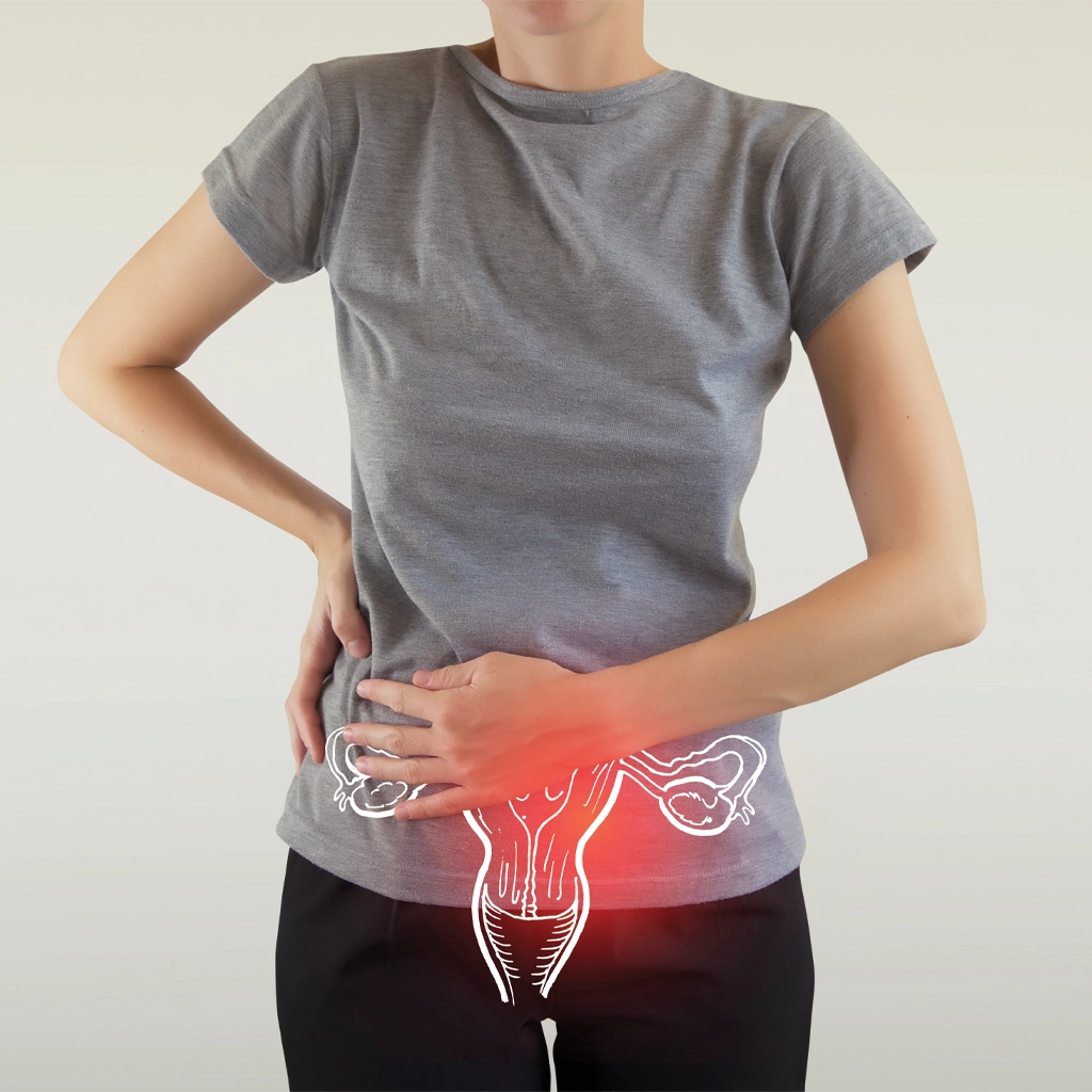 Ovarian Vein Embolization