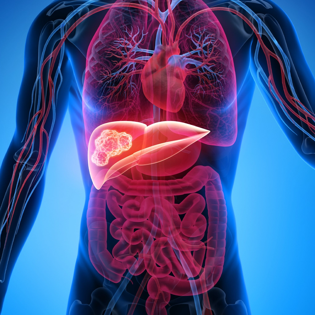Y-90 Radioembolization