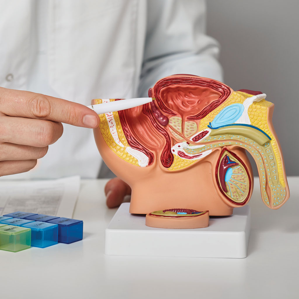Doctor explaining prostate artery embolization on medical model